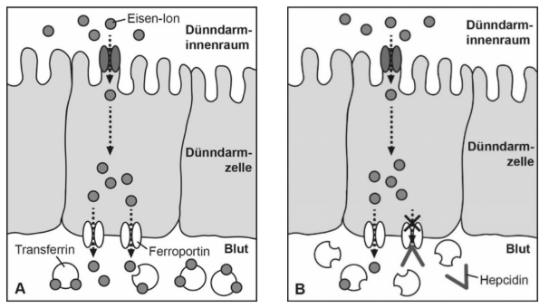 Vergleich der Eisenaufnahme im Dünndarm: Transport durch Transferrin und Ferroportin, gehemmt durch Hepcidin.